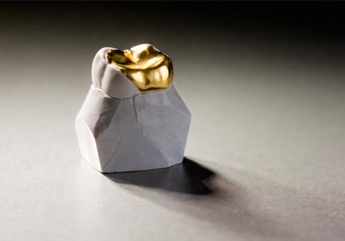 Füllungstherapie bei größeren Defekten